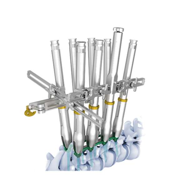TINAD失透明减少脊柱椎弓根螺钉系统